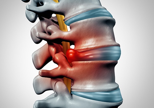 Animated spine with herniated disc
