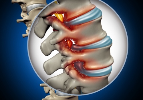 3 D image of patient with spinal stenosis