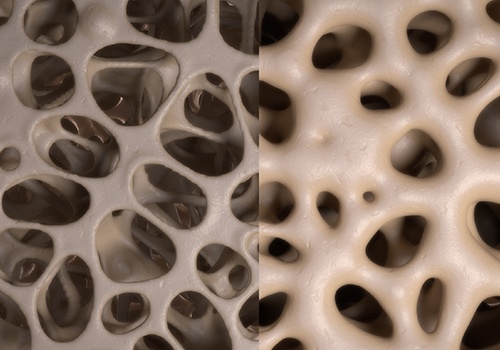 Image of bone density before and after power plate balance training
