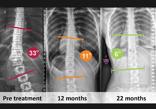 X-rays of spine before during and after ScoliBrace treatment