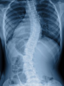 See your Naples chiropractor for beneficial treatment of scoliosis. 